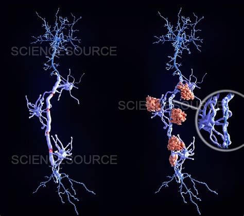 Multiple Sclerosis Healthy Neuron And Stock Image Science Source Images