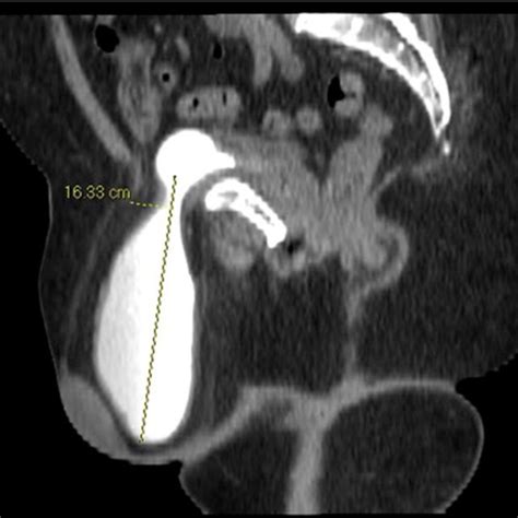 A Giant Irreducible Bilateral Inguinal Hernia In An 81 Year Old Man B