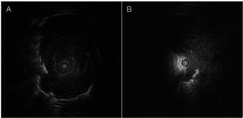 Endobronchial Ultrasound Images Showing That The Probe Was Located A