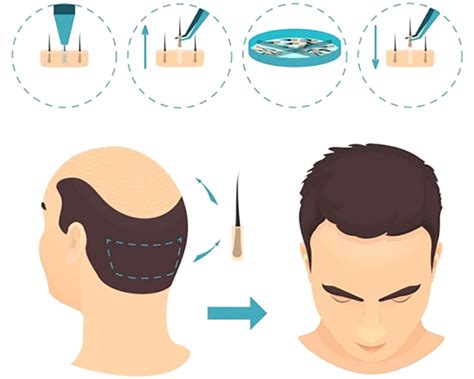 Como É Feito O Implante Capilar - Implante Capilar Masculino: O que é, como funciona? | Dr. Yoshimura