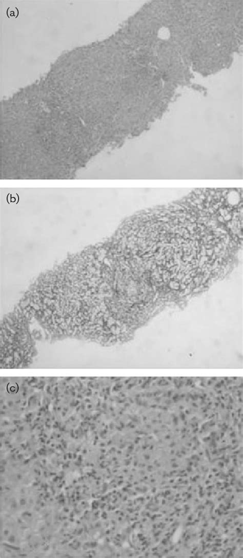 Liver Biopsy Slides Showing Cirrhosis With Nodule Formation A