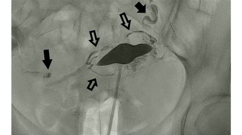 Venous Intravasation During Hysterosalpingography PMC