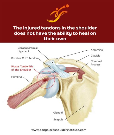 Will A Torn Shoulder Ligament Heal On Its Own - Margaret Greene Kapsels