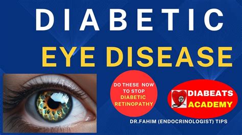 Diabetes Eye Problems Diabetic Retinopathy Best Ways To Prevent Diabetes Eye Problems Top