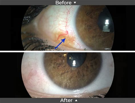 Conjunctival Nevus Removal Before and After Pictures