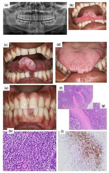 Syphilitic Glossitis