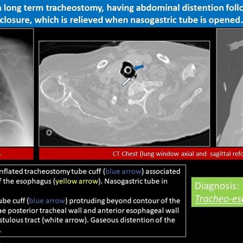 Iatrogenic Tracheoesophageal Fistula References Clinical Imaging