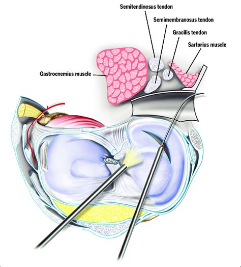 Cross Section Showing Popliteal Retractor Between The Posterior Capsule