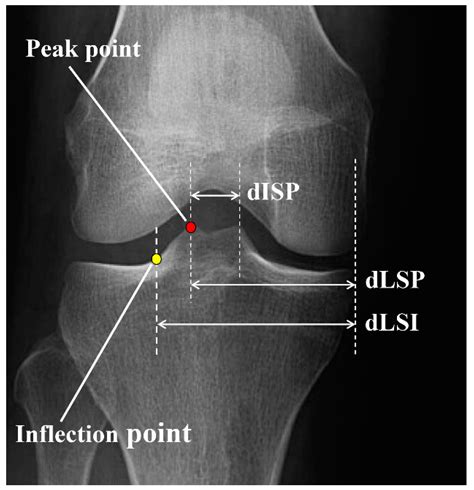 Medicina Free Full Text Anatomical Study Of The Lateral Tibial