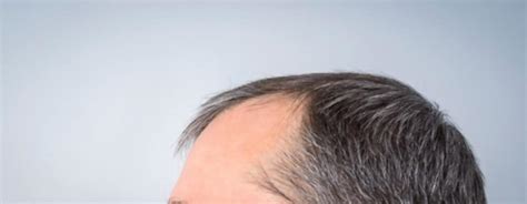 Receding Hairline Treatment What Do You Need To Know