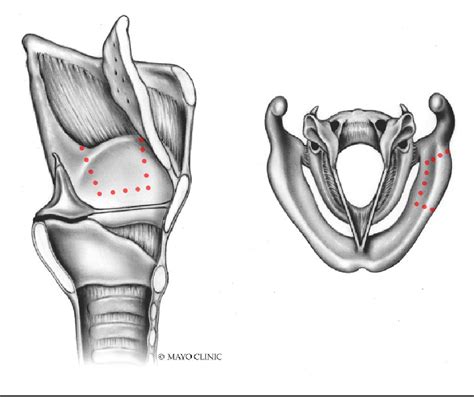 Figure 2 From Outcomes Following Transoral Laser Microsurgery With Resection Of Cartilage For