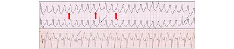 (A) Atrioventricular dissociation in the form of p waves (thick red ...