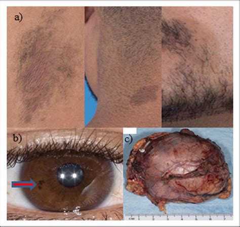 Figure 2 From The Importance Of Pheochromocytoma Case Detection In Patients With