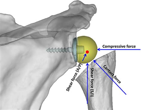 Components Of Joint Reaction Force Shown In Glenoid Lateralized Design Download Scientific