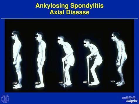 Ppt Role Of Mri In Assessment And Diagnosis Of Axial Spondyloarthritis Powerpoint Presentation