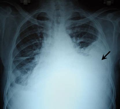 Hemothorax - Physiopedia