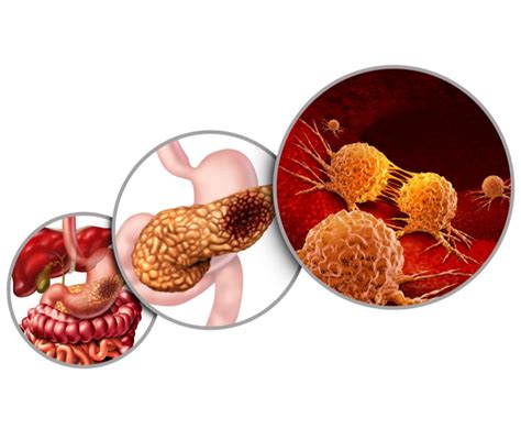 Approvare Isterico Allievo Tumore Al Pancreas Terzo Stadio Ondata