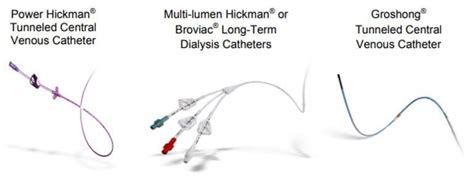 What Are Tunneled Catheters What Are Their Types