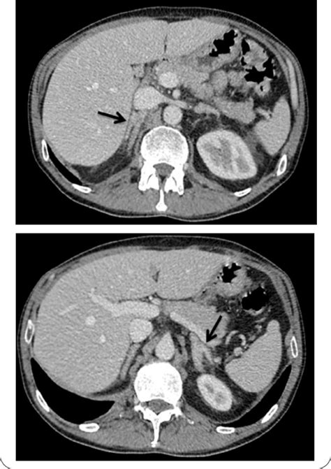 London Doctors Pioneer Treatment Of Hypertension Causing Adrenal Adenomas The Sexy Universe