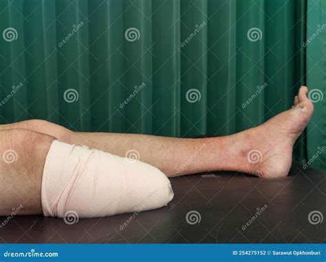 Below Knee Amputation Bandaging For Bk Prosthesis Stock Photo Image