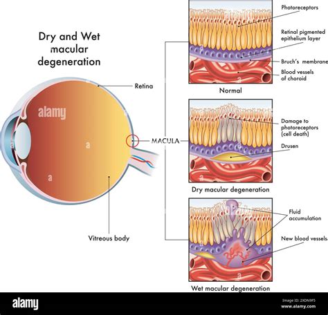 Medical illustration shows the symptoms affecting an eye affected by ...