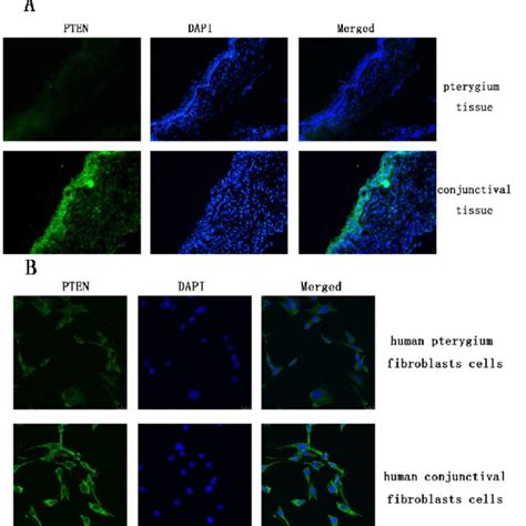 The Expression Of Pten In The Pterygium Tissue And Cultured Pterygium