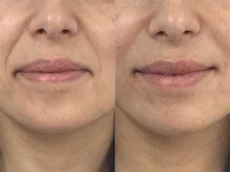 Before And After Dermal Fillers For Naso Labial Folds Dermal