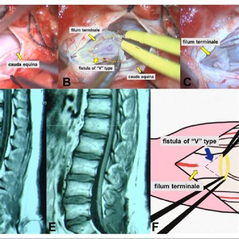 An 8 Year Old Male Patient Diagnosed With Tethered Cord Syndrome