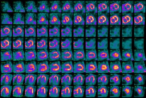 Frontiers Case Report Myocardial Perfusion Gated Spect In Pulmonary