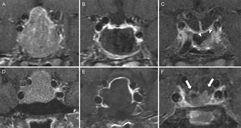 Early Postoperative MRI And Detection Of Residual Adenoma After