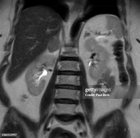 Adrenal Gland Tumor Photos And Premium High Res Pictures Getty Images