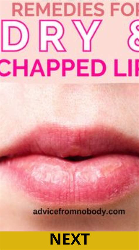 How To Get Rid Of Chapped Lips In 3 Days Artofit