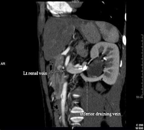 Puj Obstruction With Crossing Aberrant Vein Eurorad