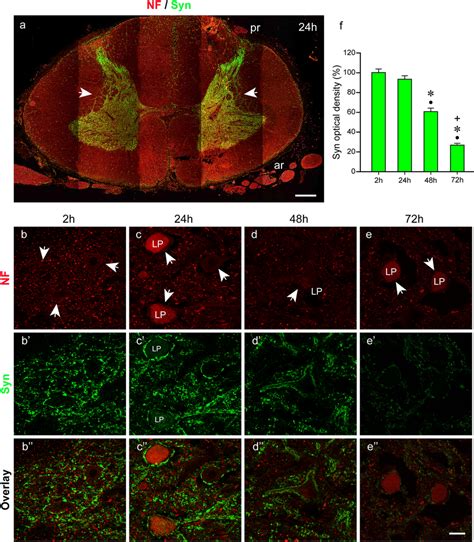 Double Labeling With Anti Neurofilament Nf And Anti Synaptophysin