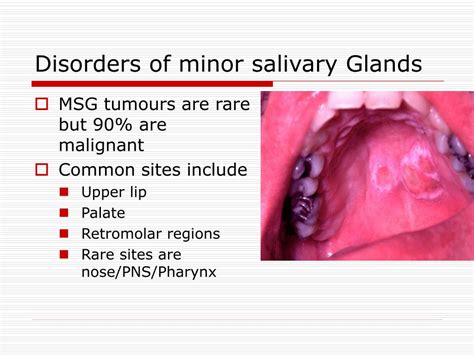 Ppt Salivary Glands Disorders Powerpoint Presentation Free Download