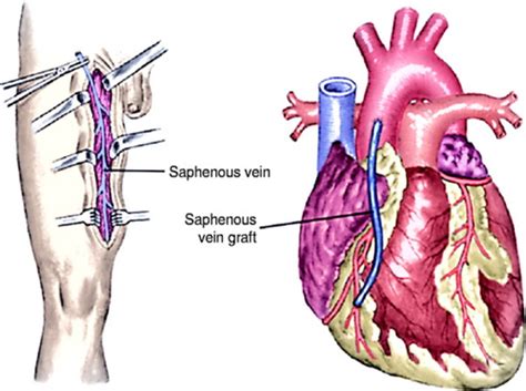 Patho Chapter 27 Cardiac Function Disorders Flashcards Quizlet