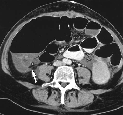 Bowel Obstruction Revealed By Multidetector Ct Ajr