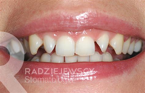 Metamorfozy Stomatologia Radziejewscy Ortodoncja I Nak Adki Invisalign