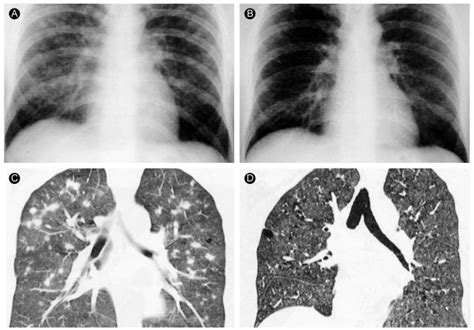 Radiographic Findings A Simple Chest Radiograph Shows Multiple