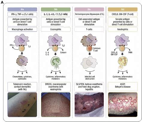 Controversies In Drug Allergy Testing For Delayed Reactions Journal