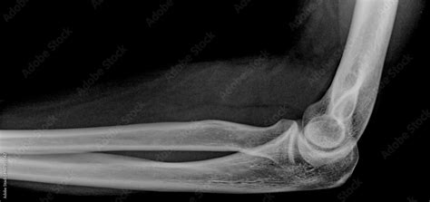 x ray image of human elbow joint Stock Photo | Adobe Stock