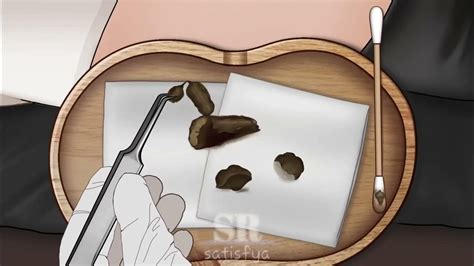 Satisfying Asmr Remove Huge Navel Stone Animation That Makes You Calm