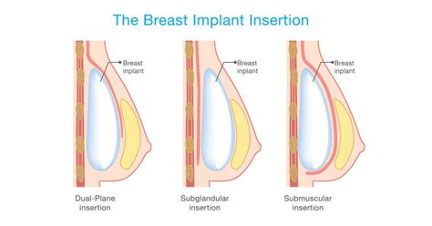 Entenda Por Que O Método Dual Plane De Mamoplastia é Revolucionário