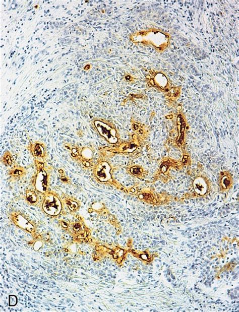 Pathology Outlines Adenosquamous Carcinoma