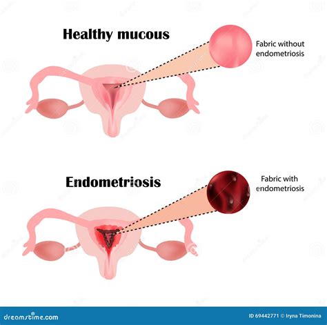 Endometriosis The Structure Of The Pelvic Organs Adenomyosis The Endometrium Stock Vector