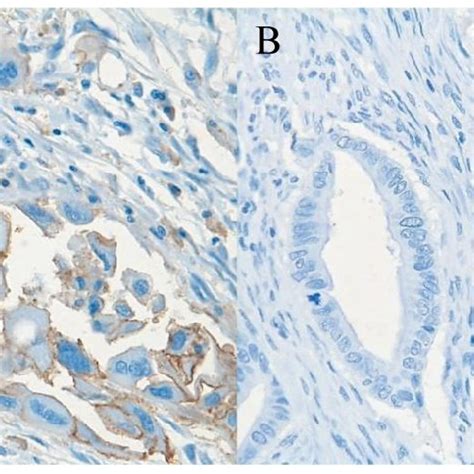 Pancreatic ductal adenocarcinoma tissue with (A) (brownish color) and... | Download Scientific ...