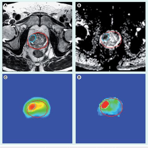 Figure 1 From Functional MRI For Tumor Delineation In Prostate