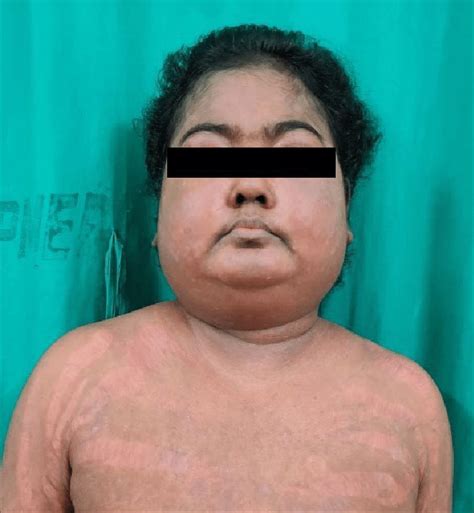 Moon Facies Seen In Exogenous Cushing Syndrome Due To Steroid Intake