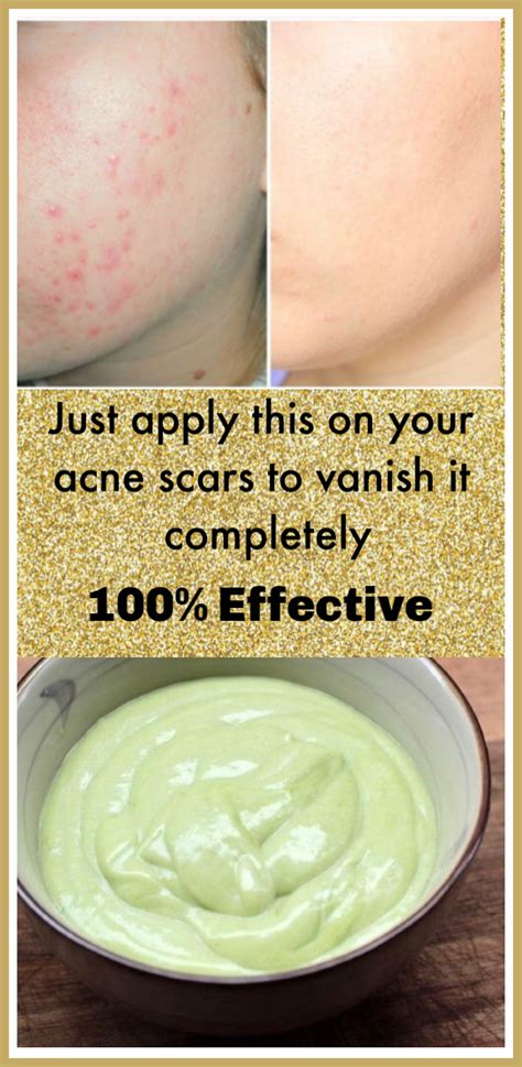 Homemade Face Mask For Acne Scars And Sensitive Skin Most