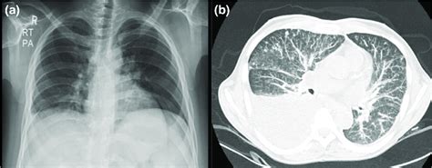 A Chest X Ray Pa View Showing Pleural Effusion And B Hrct Of The